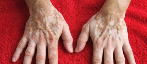 Tratamento-gratuito-vitiligo-em-SP-3