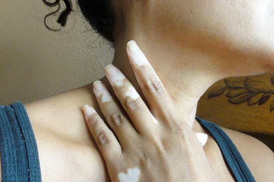 Tratamento-gratuito-vitiligo-no-RJ-1
