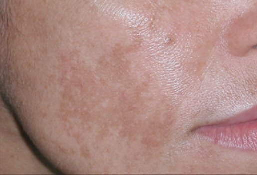 O melasma é uma mancha amarronzada que aparece no rosto. (Foto: Divulgação)